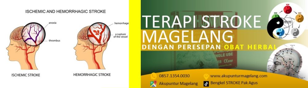 TERAPI STROKE MAGELANG – WA: 0857.1354.0030